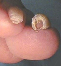Fungal nail
